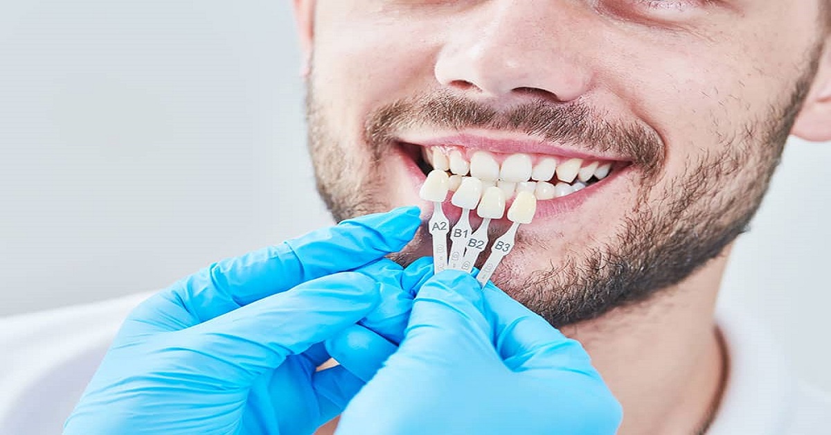 Dental Veneers: The Best Way To Beautify Your Teeth