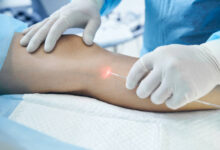Advantages Of Endovenous Laser Ablation Therapy