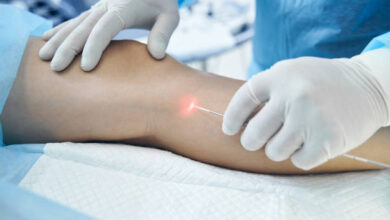 Advantages Of Endovenous Laser Ablation Therapy